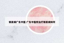 銀屑病廣東中醫(yī) 廣東中醫(yī)院治療銀屑病如何
