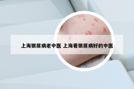 上海銀屑病老中醫(yī) 上?？淬y屑病好的中醫(yī)