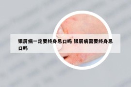 銀屑病一定要終身忌口嗎 銀屑病需要終身忌口嗎