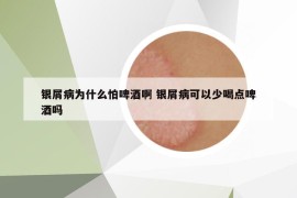銀屑病為什么怕啤酒啊 銀屑病可以少喝點啤酒嗎