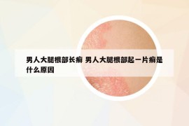 男人大腿根部長癬 男人大腿根部起一片癬是什么原因