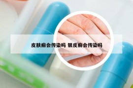 皮膚癬會(huì)傳染嗎 銀皮癬會(huì)傳染嗎
