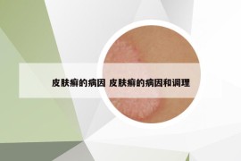 皮膚癬的病因 皮膚癬的病因和調理