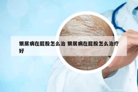 銀屑病在屁股怎么治 銀屑病在屁股怎么治療好