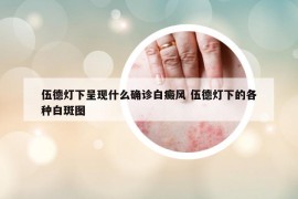 伍德燈下呈現(xiàn)什么確診白癜風 伍德燈下的各種白斑圖