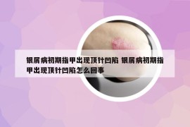 銀屑病初期指甲出現(xiàn)頂針凹陷 銀屑病初期指甲出現(xiàn)頂針凹陷怎么回事