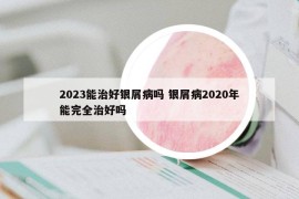 2023能治好銀屑病嗎 銀屑病2020年能完全治好嗎