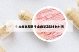 牛皮癬復(fù)發(fā)期 牛皮癬復(fù)發(fā)期多長(zhǎng)時(shí)間