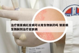 治療銀屑病紅皮病可以用生物制藥嗎 銀屑病生物制劑治療皮膚病