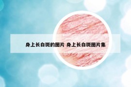 身上長(zhǎng)白斑的圖片 身上長(zhǎng)白斑圖片集