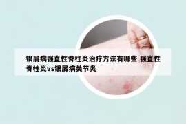 銀屑病強(qiáng)直性脊柱炎治療方法有哪些 強(qiáng)直性脊柱炎vs銀屑病關(guān)節(jié)炎