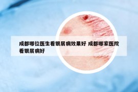 成都哪位醫(yī)生看銀屑病效果好 成都哪家醫(yī)院看銀屑病好