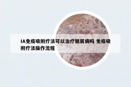 IA免疫吸附療法可以治療銀屑病嗎 免疫吸附療法操作流程