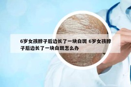 6歲女孩脖子后邊長了一塊白斑 6歲女孩脖子后邊長了一塊白斑怎么辦