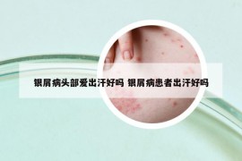 銀屑病頭部愛出汗好嗎 銀屑病患者出汗好嗎
