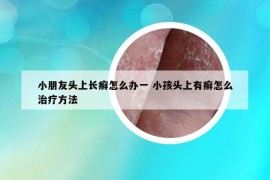 小朋友頭上長癬怎么辦一 小孩頭上有癬怎么治療方法