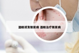 酒精誘發(fā)銀屑病 酒精治療銀屑病