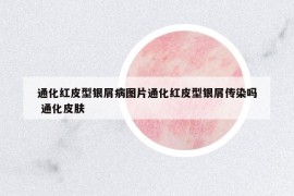 通化紅皮型銀屑病圖片通化紅皮型銀屑傳染嗎 通化皮膚