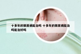 十多年的銀屑病能治嗎 十多年的銀屑病能治嗎能治好嗎