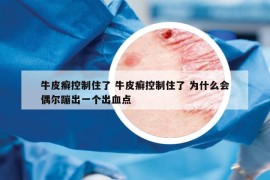 牛皮癬控制住了 牛皮癬控制住了 為什么會偶爾蹦出一個(gè)出血點(diǎn)