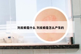 劉皮癬是什么 劉皮癬是怎么產(chǎn)生的