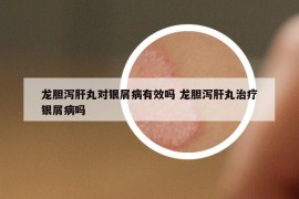龍膽瀉肝丸對銀屑病有效嗎 龍膽瀉肝丸治療銀屑病嗎