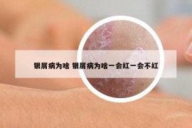 銀屑病為啥 銀屑病為啥一會紅一會不紅