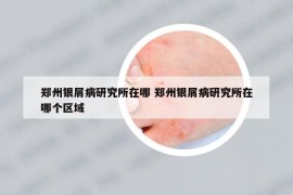 鄭州銀屑病研究所在哪 鄭州銀屑病研究所在哪個區(qū)域