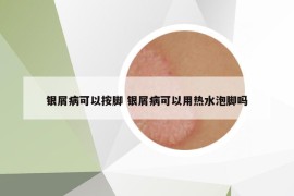 銀屑病可以按腳 銀屑病可以用熱水泡腳嗎