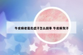 牛皮癬老是出虛汗怎么回事 牛皮癬發(fā)汗