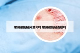 銀屑病能貼風(fēng)濕膏嗎 銀屑病能貼面膜嗎