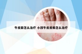 牛皮蘚怎么治療 小孩牛皮皮癬怎么治療