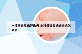 小孩得銀屑病好治嗎 小孩得銀屑病好治嗎怎么治