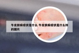牛皮膚癬癥狀是什么 牛皮膚癬癥狀是什么樣的圖片