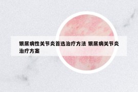 銀屑病性關(guān)節(jié)炎首選治療方法 銀屑病關(guān)節(jié)炎治療方案