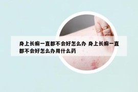 身上長(zhǎng)癬一直都不會(huì)好怎么辦 身上長(zhǎng)癬一直都不會(huì)好怎么辦用什么藥