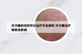 片仔癀的功效可以治療牛皮癬嗎 片仔癀治療哪些皮膚病