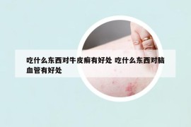 吃什么東西對(duì)牛皮癬有好處 吃什么東西對(duì)腦血管有好處