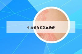 牛皮癬在家怎么治療