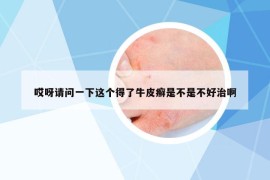 哎呀請問一下這個得了牛皮癬是不是不好治啊