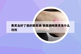 黃芪治好了我的銀屑病 銀屑病喝黃芪有什么功效