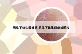 男生下體生蘚癥狀 男生下體生蘚癥狀圖片