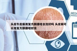 頭皮牛皮癬用復(fù)方酮康唑會(huì)洗好嗎 頭皮癬可以用復(fù)方酮康唑軟膏