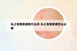 頭上有銀屑病用什么藥 頭上有銀屑病怎么止癢