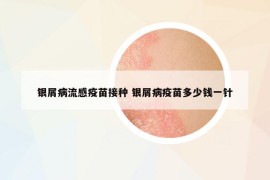 銀屑病流感疫苗接種 銀屑病疫苗多少錢一針