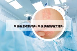 牛皮癬患者能曬嗎 牛皮膚癬能曬太陽(yáng)嗎