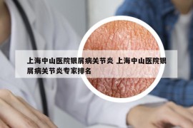上海中山醫(yī)院銀屑病關(guān)節(jié)炎 上海中山醫(yī)院銀屑病關(guān)節(jié)炎專家排名