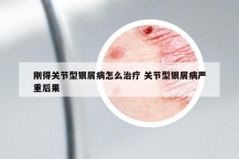 剛得關(guān)節(jié)型銀屑病怎么治療 關(guān)節(jié)型銀屑病嚴(yán)重后果