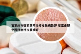 石家莊市哪家醫(yī)院治療皮膚病最好 石家莊那個醫(yī)院治療皮膚病好
