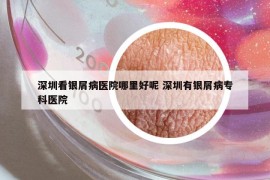 深圳看銀屑病醫(yī)院哪里好呢 深圳有銀屑病專科醫(yī)院